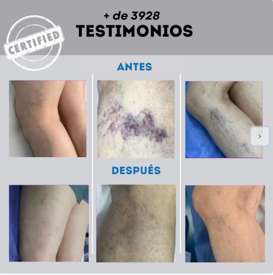 Spray Venas Varices (120ML) + Splash Relajante (60ML)